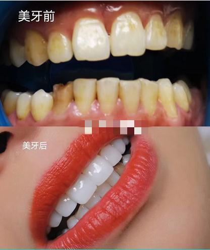 贵阳美牙培训学校(专业美牙培训学校)